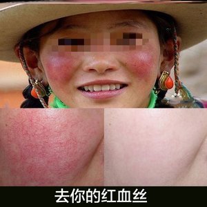 脸部角质层增厚