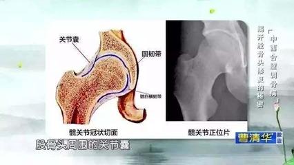 股骨头囊变是怎么回事