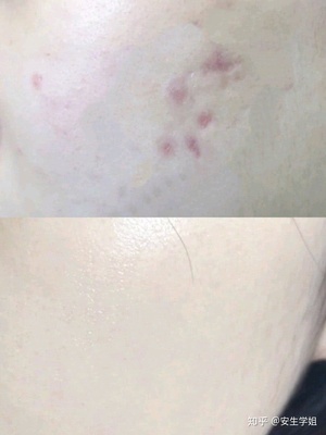 脸上红肿痘痘痘印