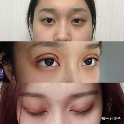 广西眼部整形