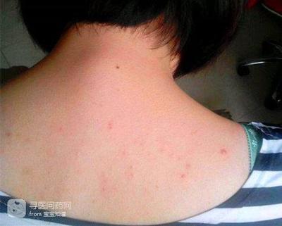 后背长了痘痘怎么回事啊