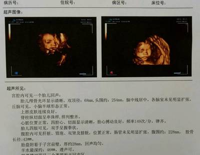 怀孕6个多月胎动少正常吗