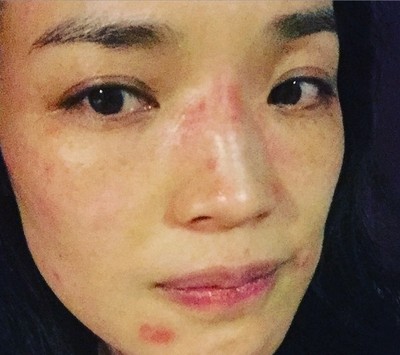 痘痘严重到快烂脸了