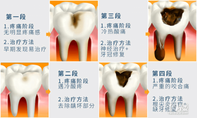 补牙一般要多久