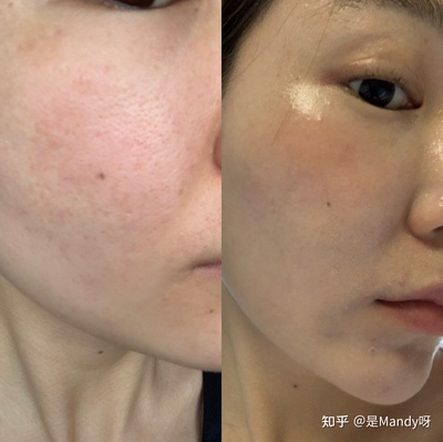 脸上有痘痘能打水光针吗