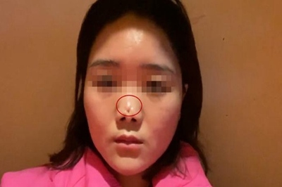 半肋骨隆鼻有后遗症吗