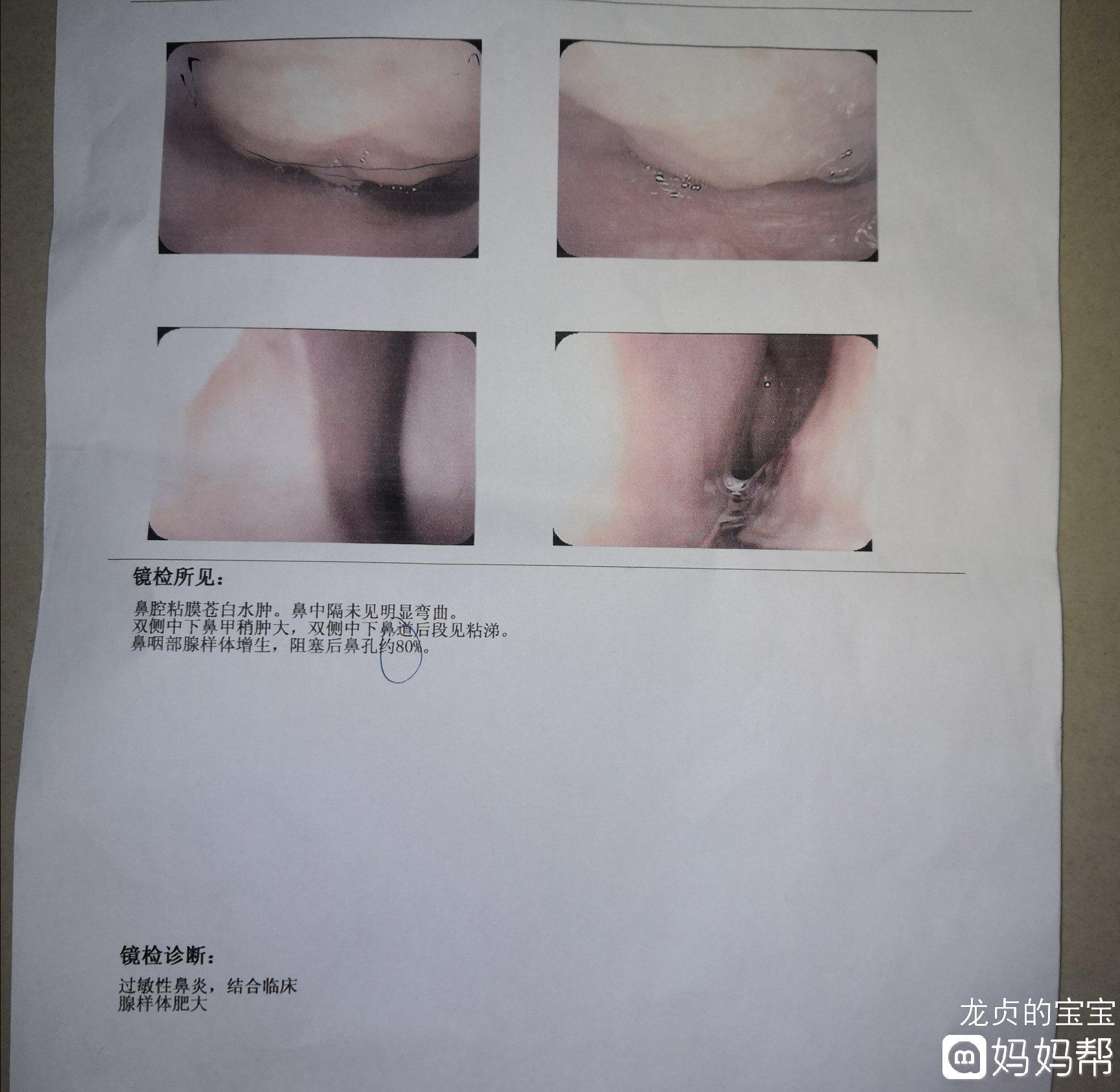 三岁宝宝扁桃体肥大怎么办