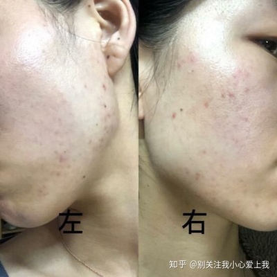 左边嘴巴长痘痘是什么原因