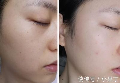 脸上红肿痘痘痘印