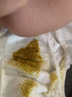 宝宝的便便有酸臭味