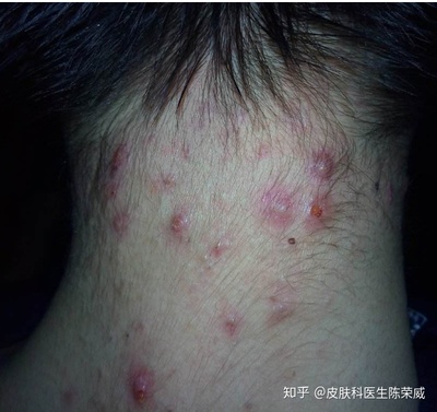 后背上长痘痘怎么回事