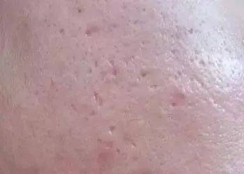 挤痘痘怎么找毛孔