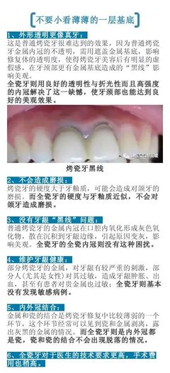 烤瓷牙和全瓷牙哪种好