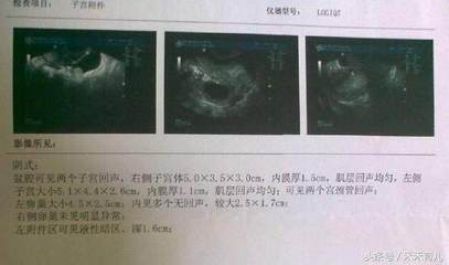 造影做完多久可以怀孕