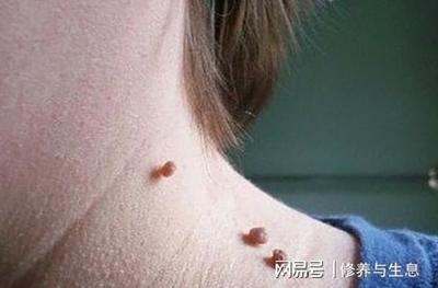 怎么去腋下的痘痘