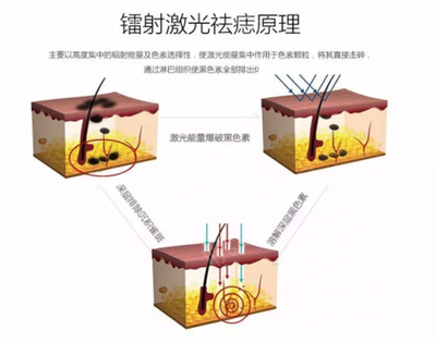 激光祛痣原理