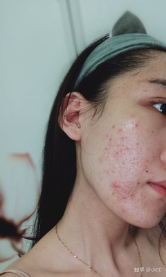 脸上的痘痘怎么消炎