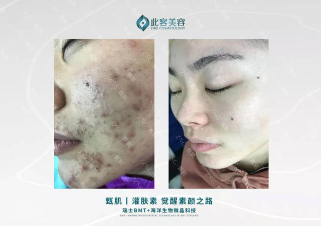 激素脸一保湿就爆痘痘