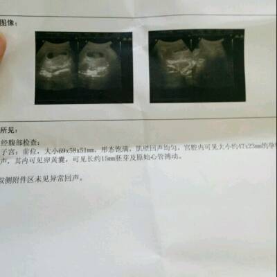 女生白带多是怀孕了吗