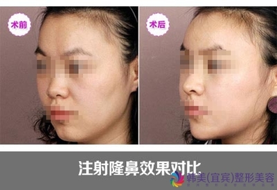 隆鼻有哪几种