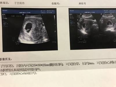 怀孕恶心不吐是男孩吗