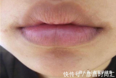 嘴唇长了痘痘