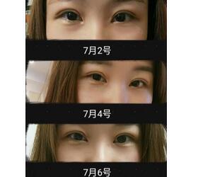 双眼皮刀疤多久能恢复