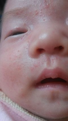 脸上长小疙瘩是怎么回事