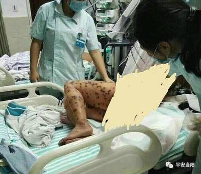 被马蜂蛰了怎么治疗