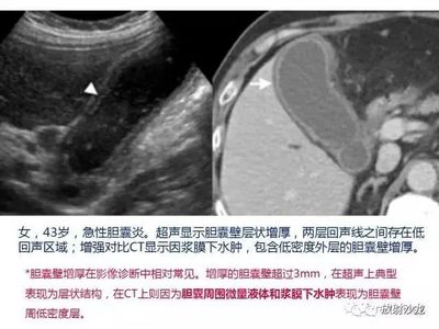 胆囊表面粗糙是怎么回事