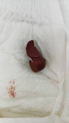 拉红色的屎是怎么回事