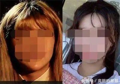 隆鼻等老了以后后遗症