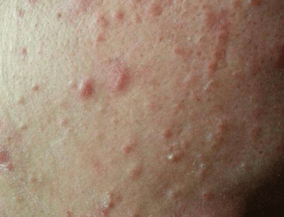 挤痘痘把脸挤肿了