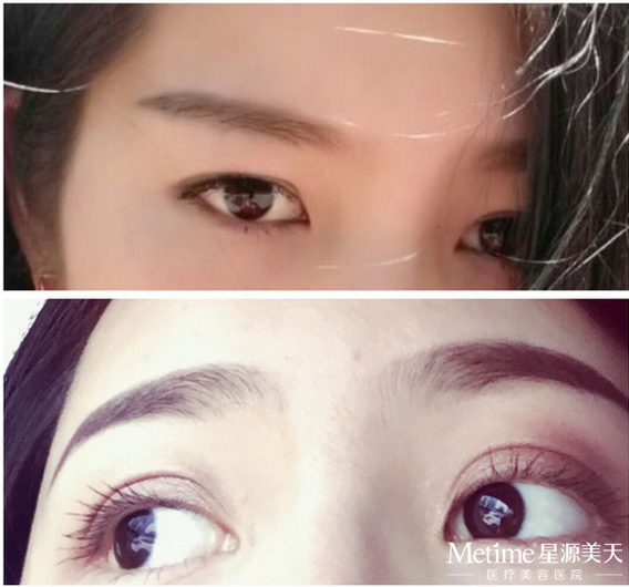 迅速变双眼皮