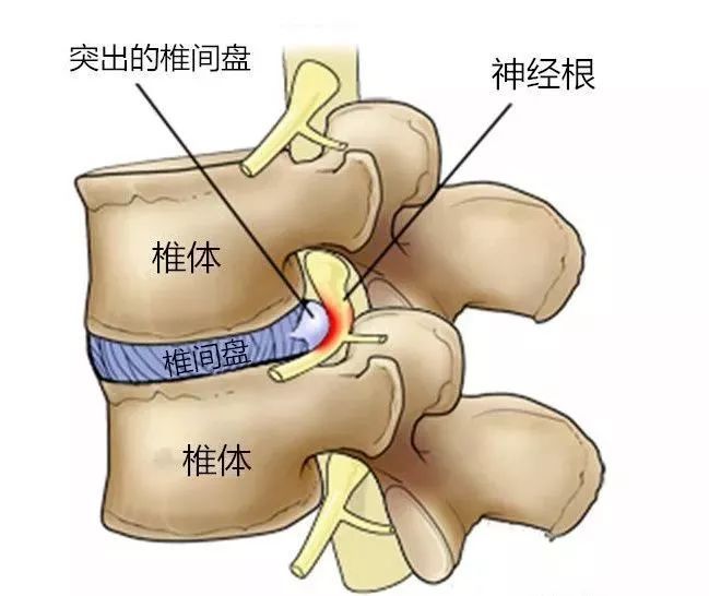 腰间盘突出压迫神经怎么治疗