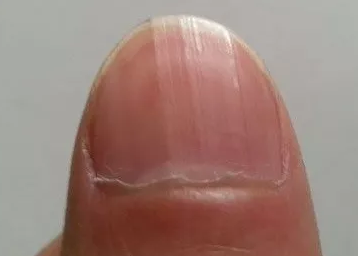 孩子手指甲有竖纹是怎么回事