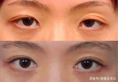 什么年龄双眼皮