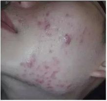 白色的大痘痘是什么原因