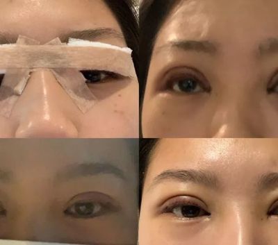 全切双眼皮照片