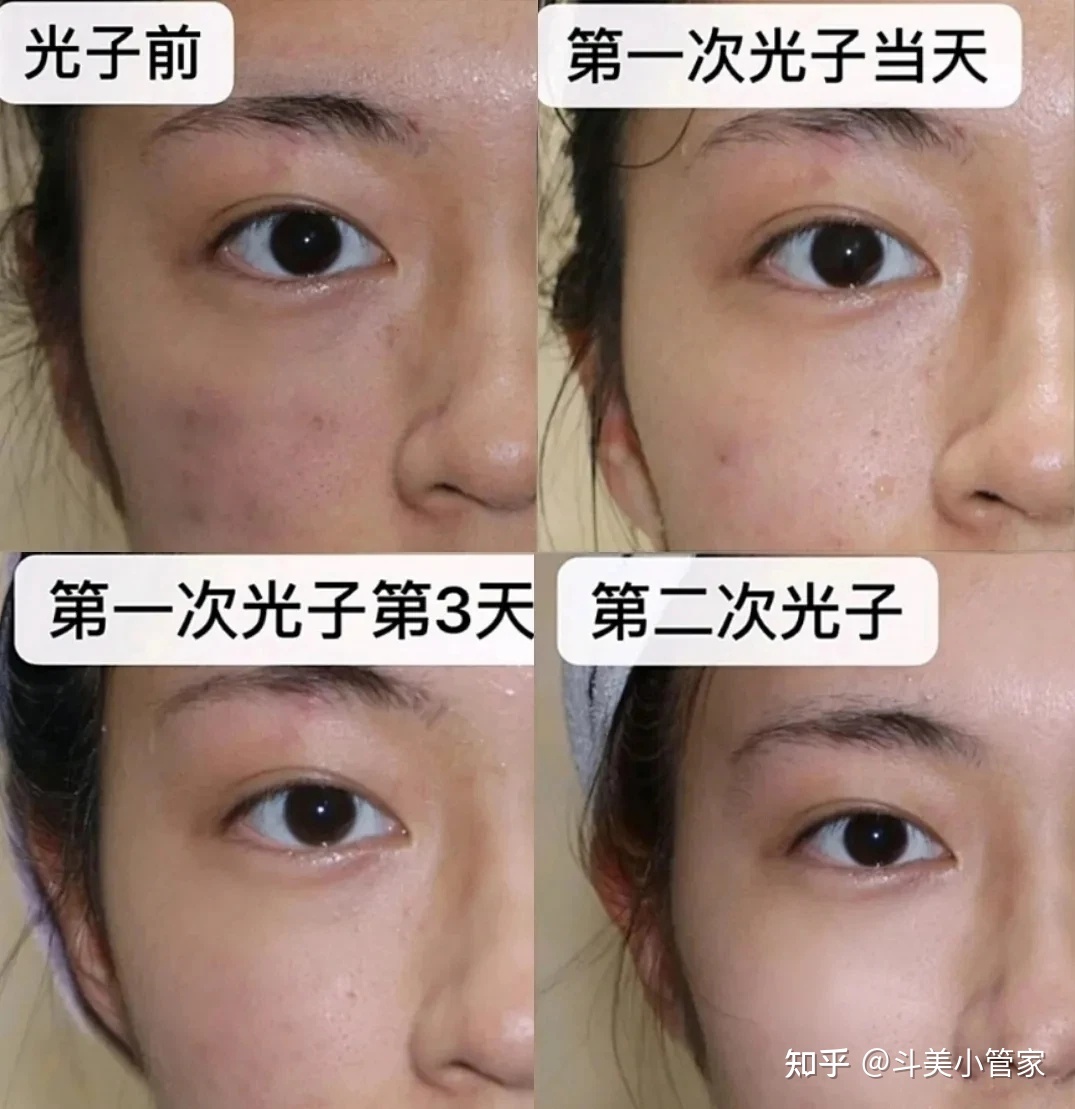 痘痘肌可以光子嫩肤吗