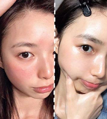红血丝皮肤用什么面膜