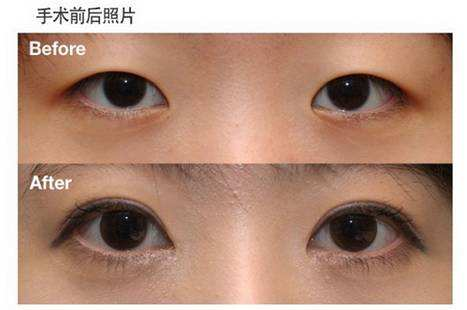 眼角老流泪是怎么回事