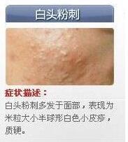 痤疮粉刺最有效的药