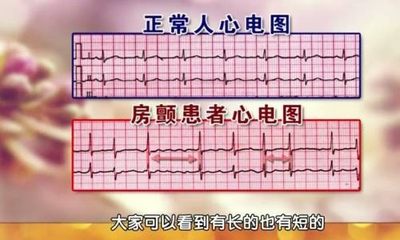 心颤是怎么回事严重吗