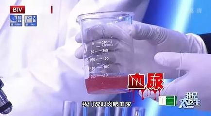 小便茶色是怎么回事