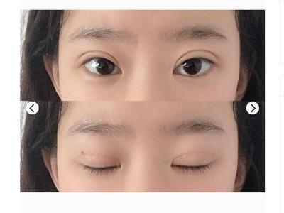 双眼皮多久能吃酱油