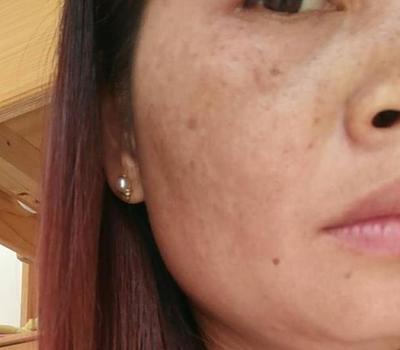 长痘痘毛孔粗大肤色不均
