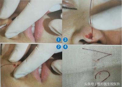 注射隆鼻如何取出