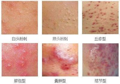 丘疹型痘痘严重么