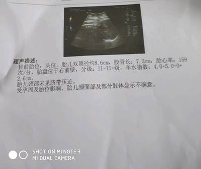 足月胎儿股骨长标准